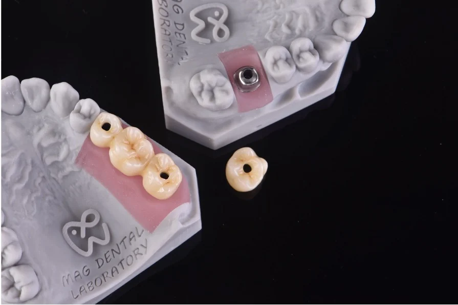 Implant-supported crowns displayed alongside a dental implant model