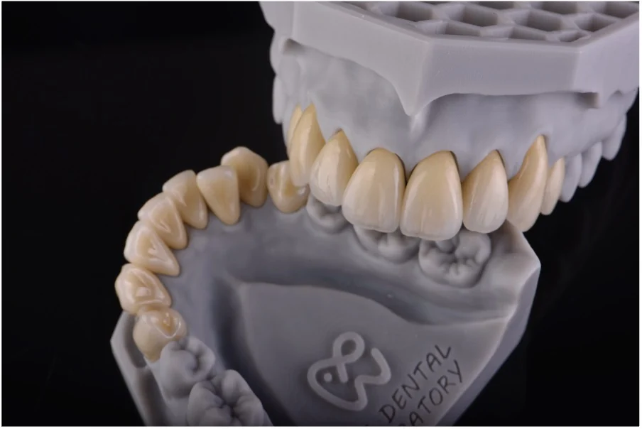 Detailed ceramic crown and bridge restorations on a dental model